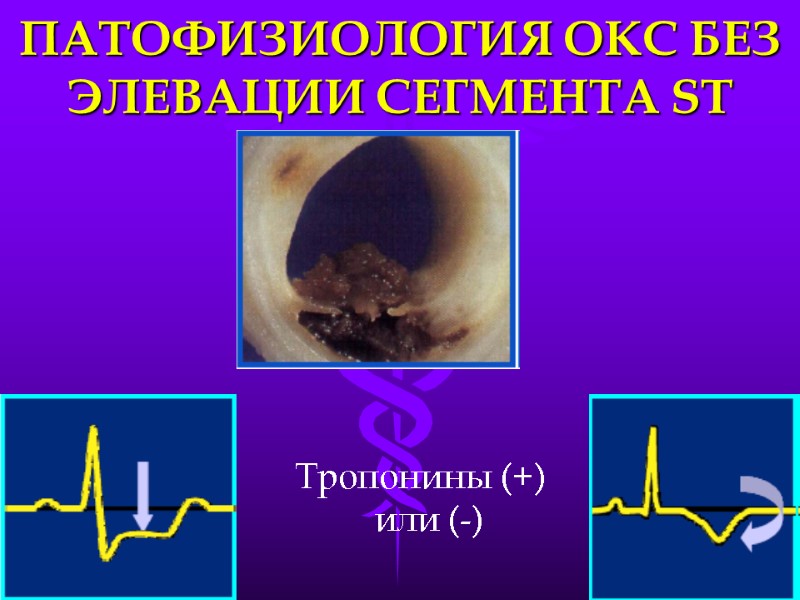ПАТОФИЗИОЛОГИЯ ОКС БЕЗ ЭЛЕВАЦИИ СЕГМЕНТА ST Тропонины (+)      